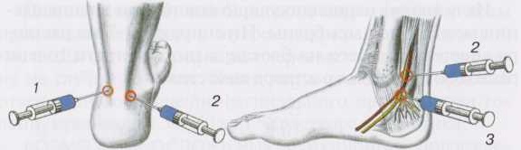 Блокада заднего большеберцового и икроножного нервов по Брауну Блокада заднего большеберцового и икроножного нервов по Брауну